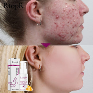 Cleaning Serum Shrink Pores Eliminates Acne Treatment Oil control